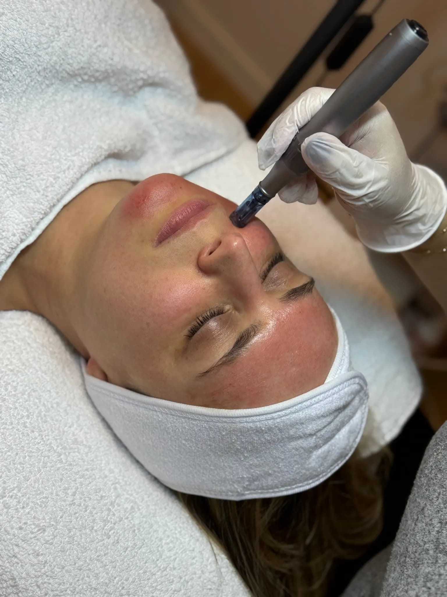 Sahel Beauty Frankfurt — Microneedling Behandlung