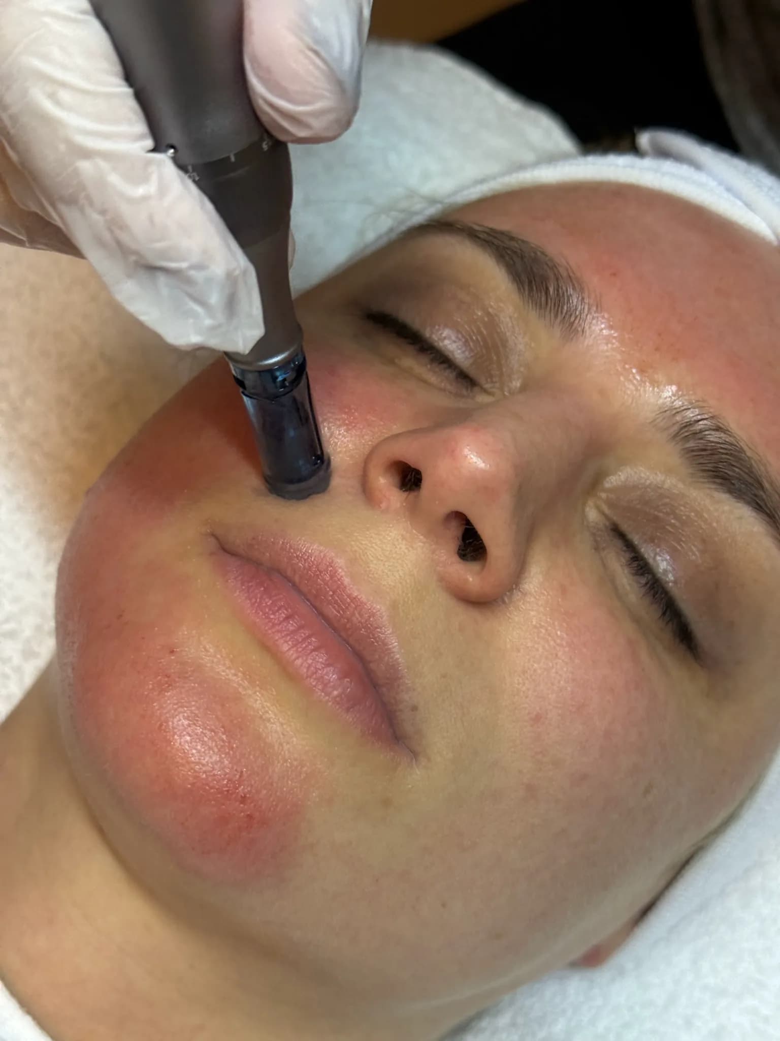 Bright Face – Microneedling mit Phi Serum — Sahel Beauty Frankfurt (Bild 1)