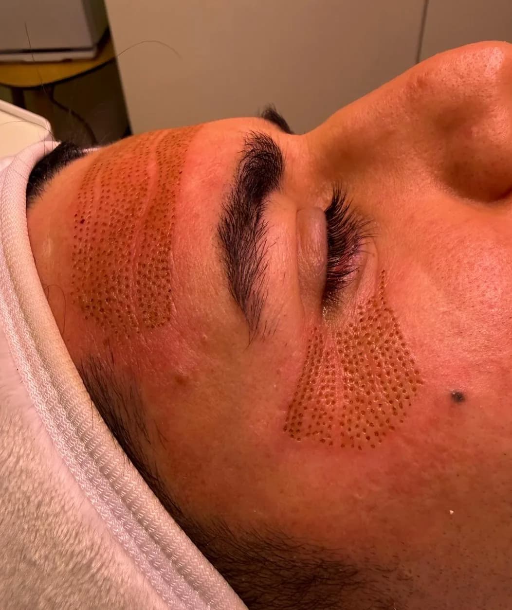 Pigmentflecken – Plasma Pen Behandlung — Sahel Beauty Frankfurt (Bild 1)