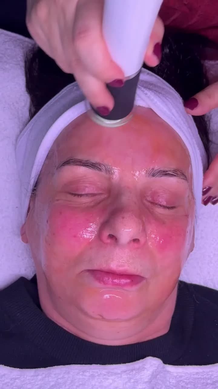 Pollogen Therapy – OxyGeneo — Sahel Beauty Frankfurt (Bild 1)